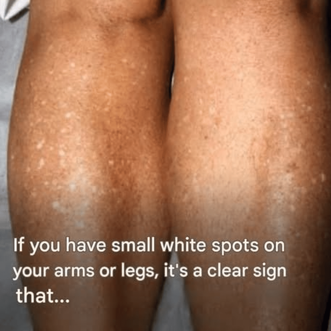 Understanding and Treating White Spots on Skin: A Comprehensive Guide